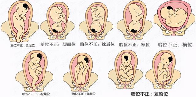 寶寶胎位不正你會看嗎？