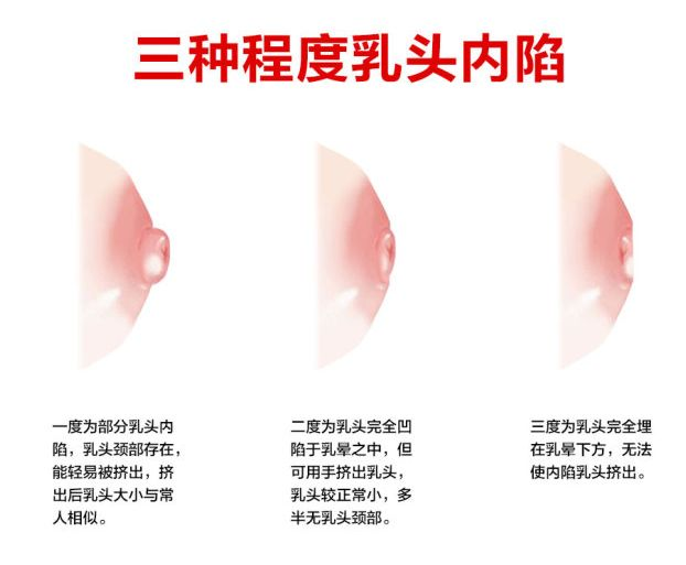 乳頭凹陷的媽媽該如何哺乳？