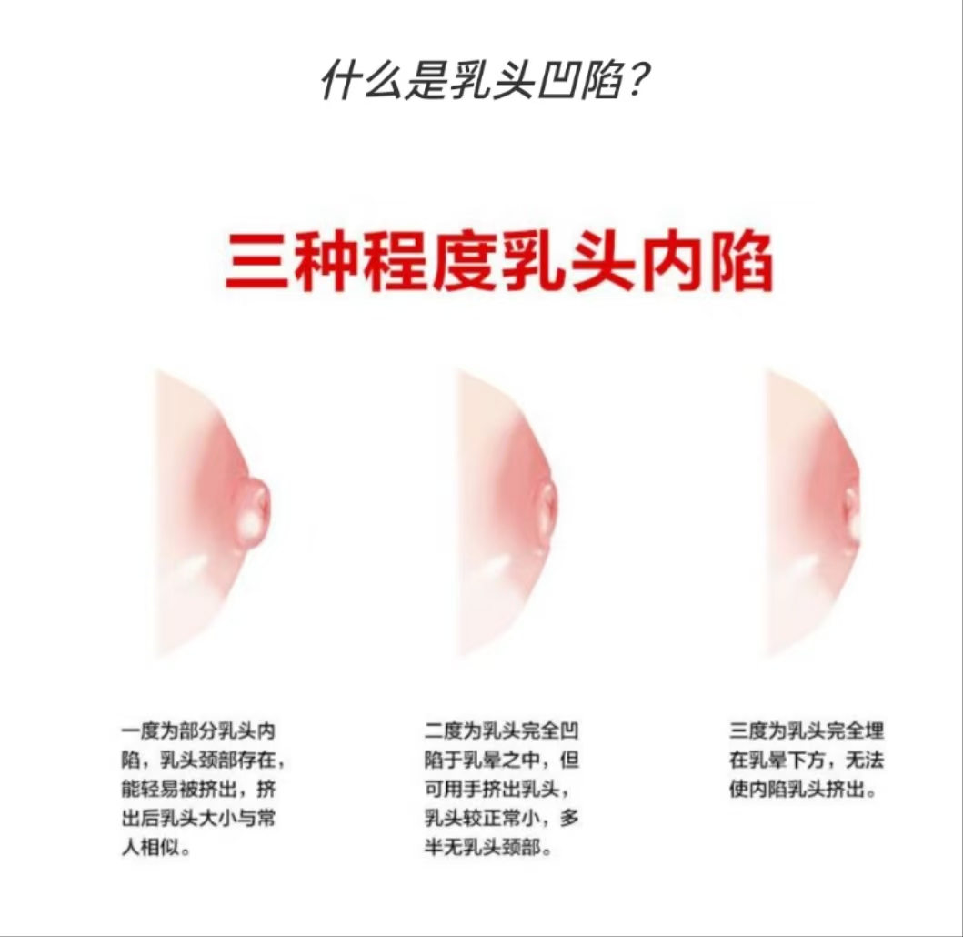 乳頭凹陷的媽媽該如何哺乳？